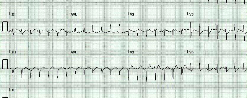 ECG opdracht terugkomdag 08/04/2019